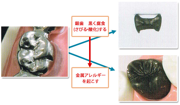 では、すでに治療した歯はどうしたら長持ちするのでしょう？