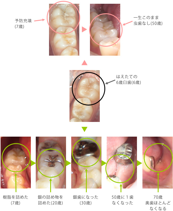 では、すでに治療した歯はどうしたら長持ちするのでしょう？