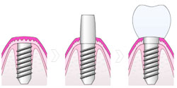 インプラントの治療とは