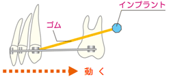 インプラント矯正