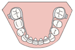 舌（裏）側矯正