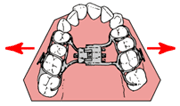 上顎急速拡大装置（固定式） [うわあごきゅうそくかくだいそうち]
