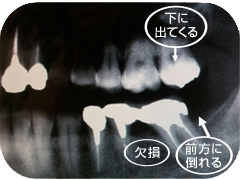 インプラント治療の一例