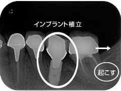 インプラント治療の一例