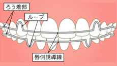 保定装置 (リテーナー)