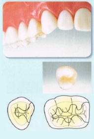 かぶせもの（クラウン）＆詰め物（インレー）