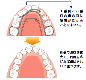 咬合誘導の具体的な例