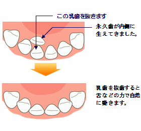 咬合誘導の具体的な例