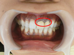 被せ物の境と歯茎に境目の黒い線が目立つ