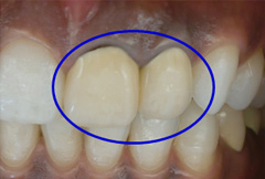 被せ物の境と歯茎に境目の黒い線が目立ち、黄ばむ