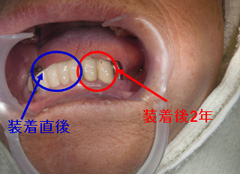 保険の前歯の被せ物の経年比較