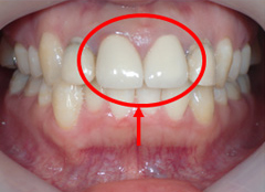 前歯2歯セラミック装着直後