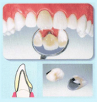 メタルボンド　かぶせもの（クラウン）