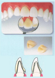 かぶせもの（クラウン）＆詰め物（インレー）