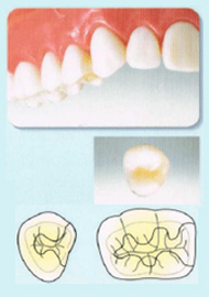 かぶせもの（クラウン）＆詰め物（インレー）