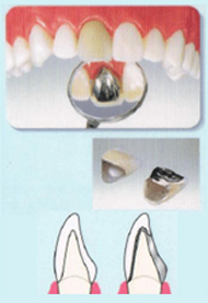 硬質レジン（クラウン　かぶせもの）
