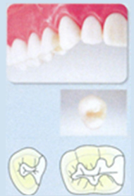 コンポジットレジン（インレー　詰め物）