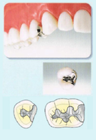 銀歯　かぶせもの（クラウン）＆詰め物（インレー）
