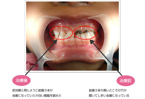 写真：小児の歯科治療の一例