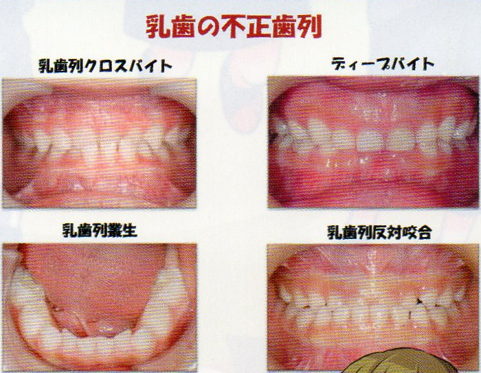 写真：乳歯の不正歯列